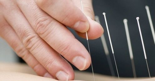 Health problems? Why not try some acupuncture?