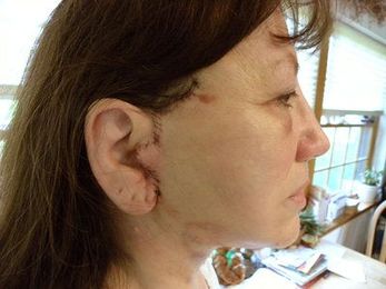 Eyebrow Droops After Mini-lift. Doc Suggesting Botox? (photo)