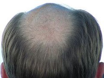 Exercising to Prevent Hair Loss