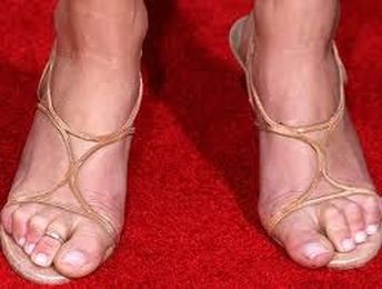 My second toe looks like a claw-do I have a Hammer toe?