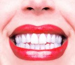 Questions You Should Ask Before Whitening Your Teeth