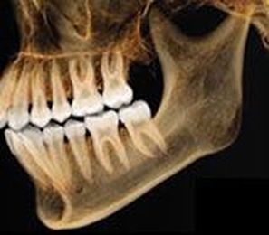 Understanding the New Standard in Dentistry: CAT Scans