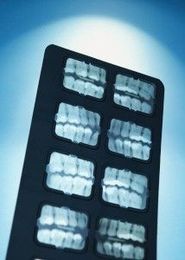 Potential Reasons for Tooth Extraction