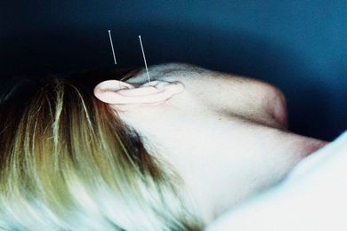 Is Acupuncture an Antidote for Allergies?