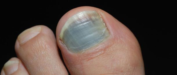 Why is my Toenail Discolored? Pt. 2