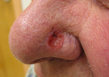 Is that skin cancer?