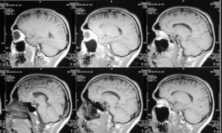Study: Brain Implant Predicts Seizures