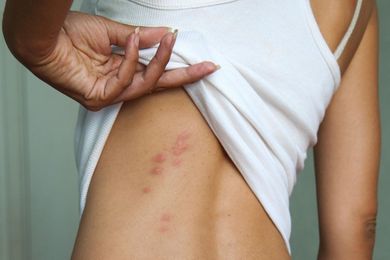 What are Mystery Bugs? Can They Bite?