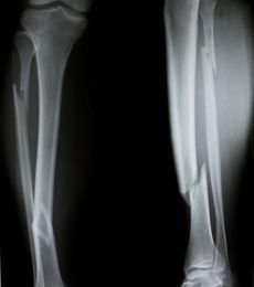 Scientists uncover method of athletic injury prevention