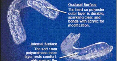 What is a Mouth Guard and Why Do I need one?