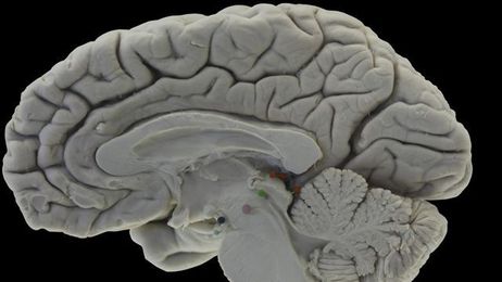 Study links copper intake to Alzheimer's disease