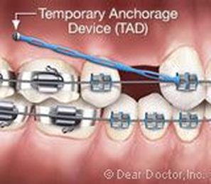 TADs Contribute to Greater Precision During Orthodontic Treatment