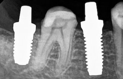 Cosmetic Dental Treatments to Consider
