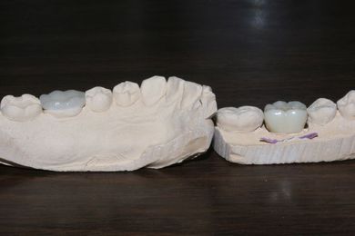 Crowns, Onlays and the Dental Pulp