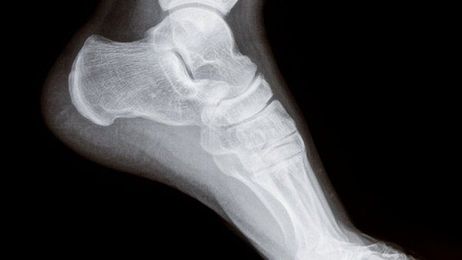 Ask Well: Ankle Replacements