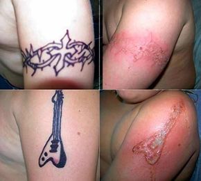 Temporary tattoos could cause permanent scarring