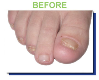 No More Ugly Toenails!