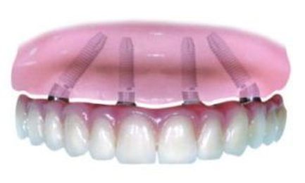 How do All-on-Four implants compare to traditional dental implants?