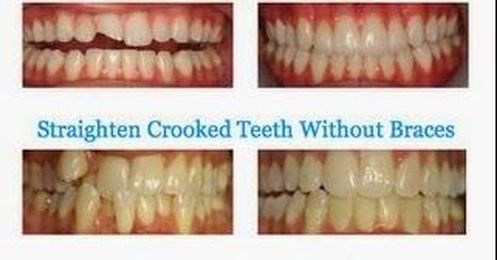 Basics of Cosmetic Dentistry