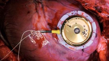 Energy Harvesting Poised To Eliminate Pacemaker Battery