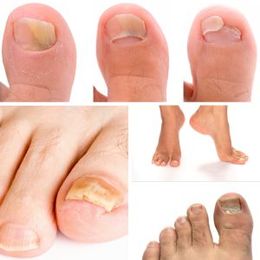 Win FREE Laser Therapy for Toenail Fungus!