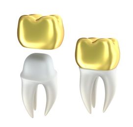 A Look at How Dental Crowns Work