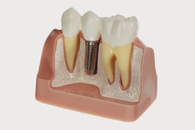 What to Consider before Getting Dental Implants