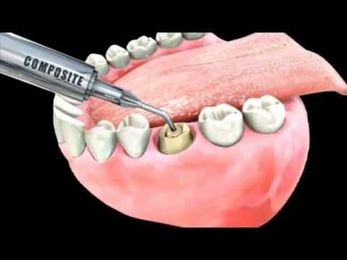 Porcelain Fused to Metal