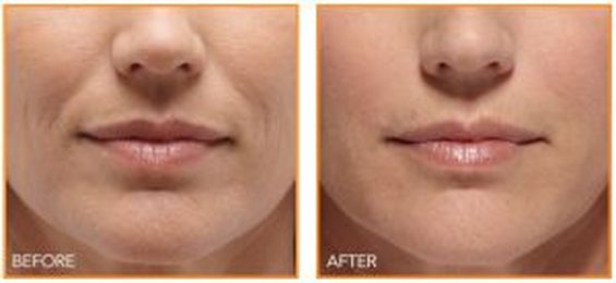 The Many Benefits of Dermal Fillers