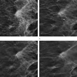 Tomo plus digital mammography decreases recalls by 37%