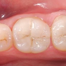 It's an Art: Determining Tooth Color in Composite Resin Restorations