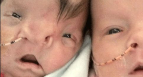 Watch surgeons reconstruct this little girl's face with 3D printing