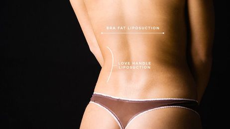 I Had a Butt Lift Consultation: What It’s Really Like