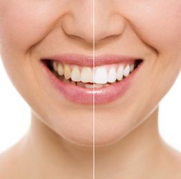 123 Dentist's Guide To A Whiter Smile