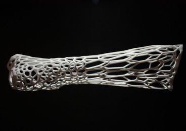 This beautiful 3D printed cast cuts down on the pain of a broken arm