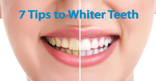 7 Tips to Whiter Teeth