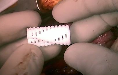 A 3-D-printed airway splint cures babies, then disappears