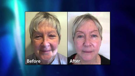 In-Office Mini Face Lift