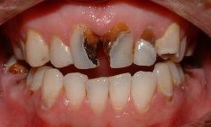 It’s Not Just A Clever Name: Mouthguards Guard Mouths