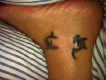 Rue that tattoo? In one of life's few do-overs, laser removal takes off
