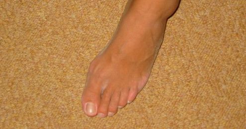 3 Ways To Get Rid Of Stubborn & Painful Ingrown Toenails