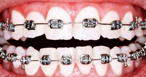 Why Is America Obsessed With Perfecting Its Teeth?