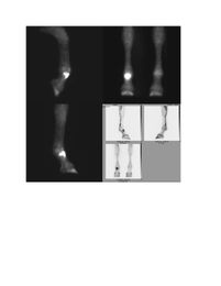 MRI vs. Nuclear Scintigraphy