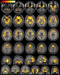 Substance Abuse Linked With Decreased Brain Volume In Women