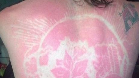 Why Doctors Are Warning About Sunburn Art
