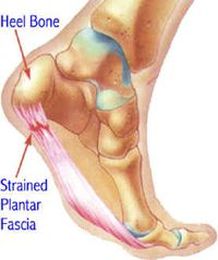 Understanding Plantar Fasciitis and Finding Remedies for the Pain