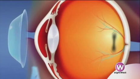 Correct your vision without surgery