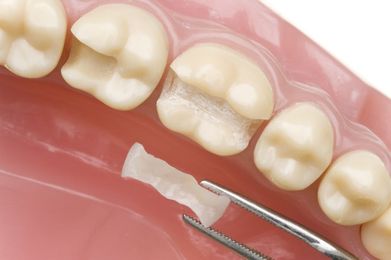 Could a Dental Filling Be Right for You?