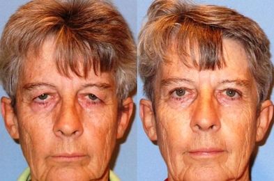 'I Had to Use My Eyebrows to Drive'