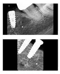 Crestal Bone Loss: Can it be repaired?